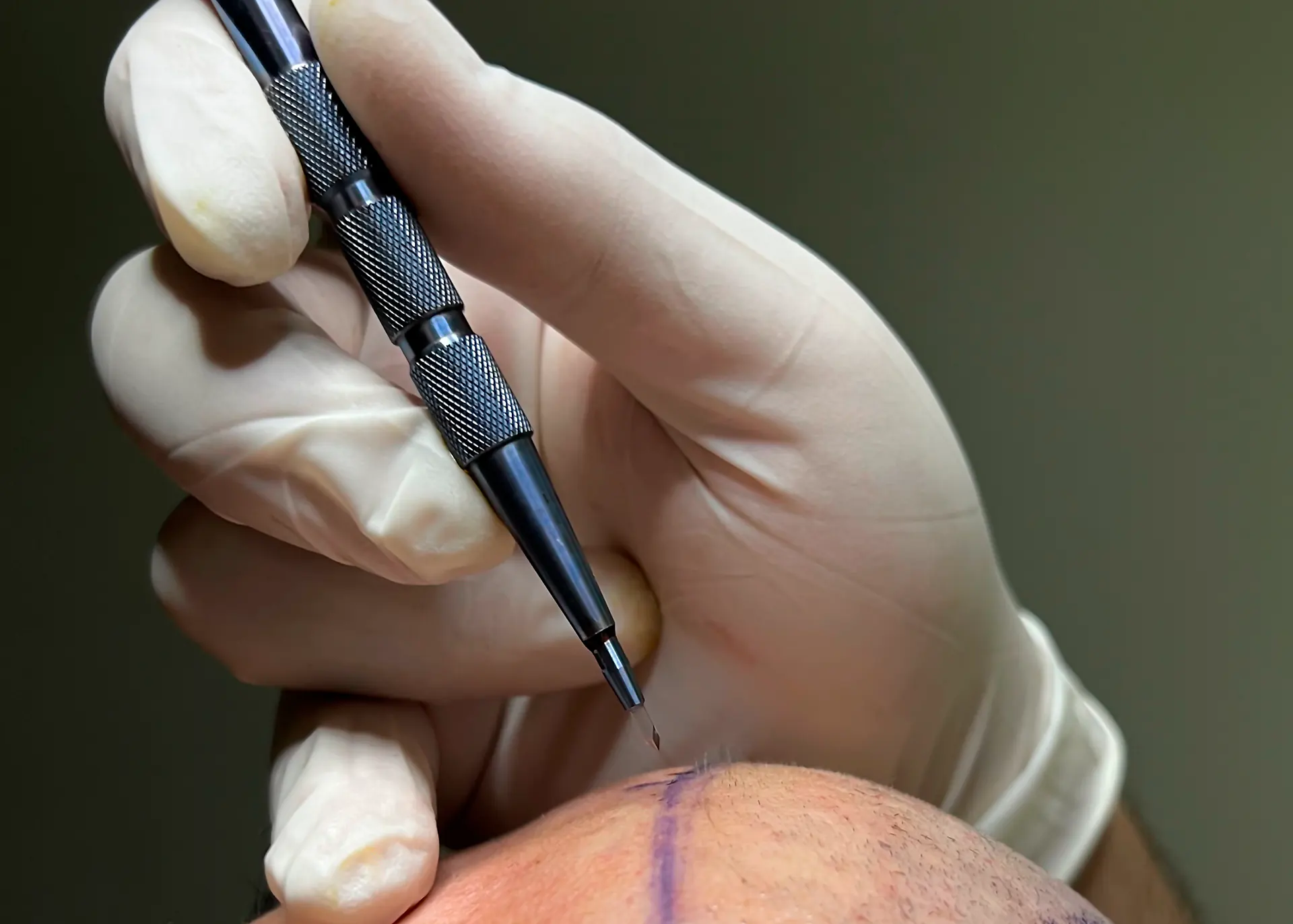 Can Hair Transplant Create a Naturally Dense Appearance?