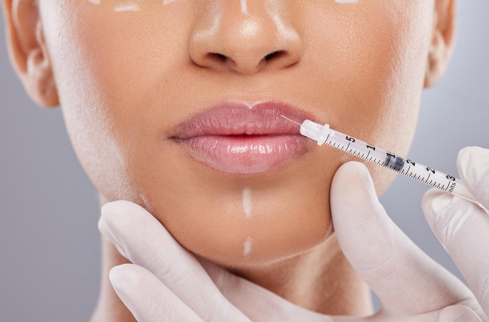 Can Russian Lip Fillers Correct Lip Asymmetry?