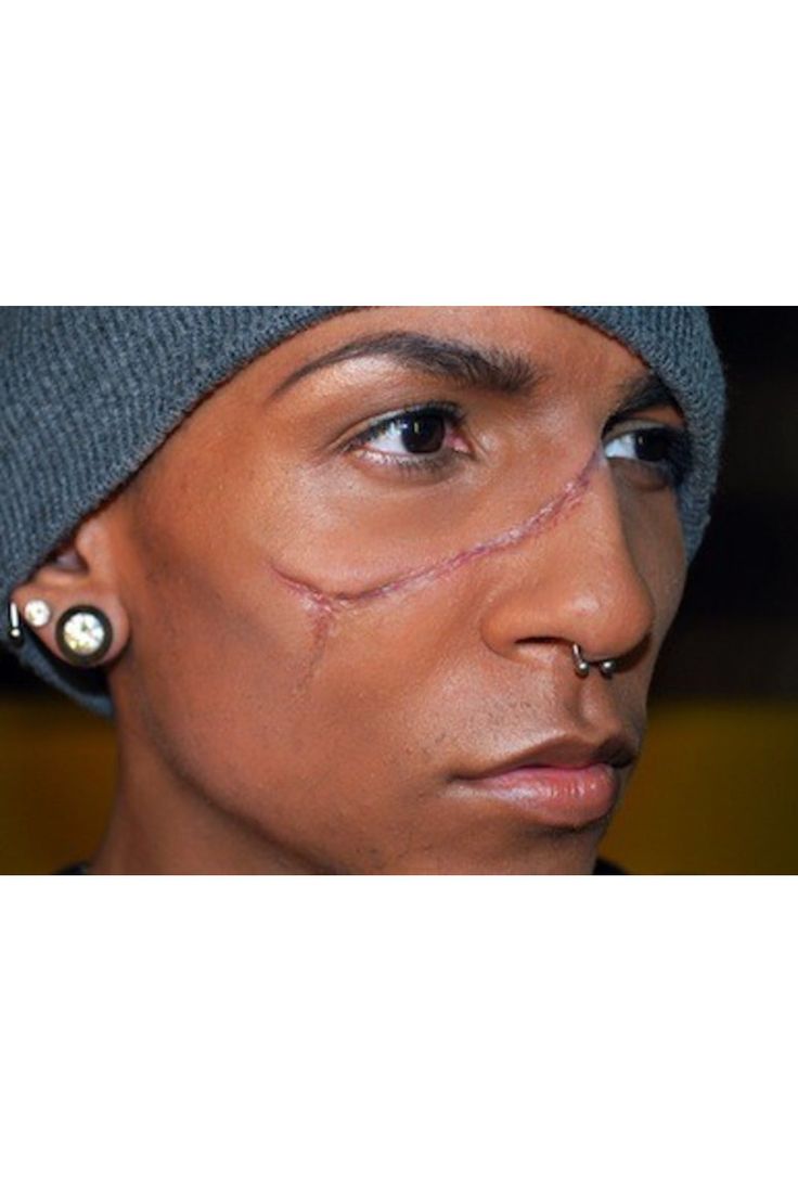Can Facial Scar Treatment Help Smooth Raised Scars?