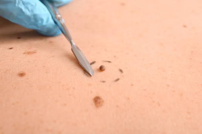 How Long Does Wart Removal Usually Take?