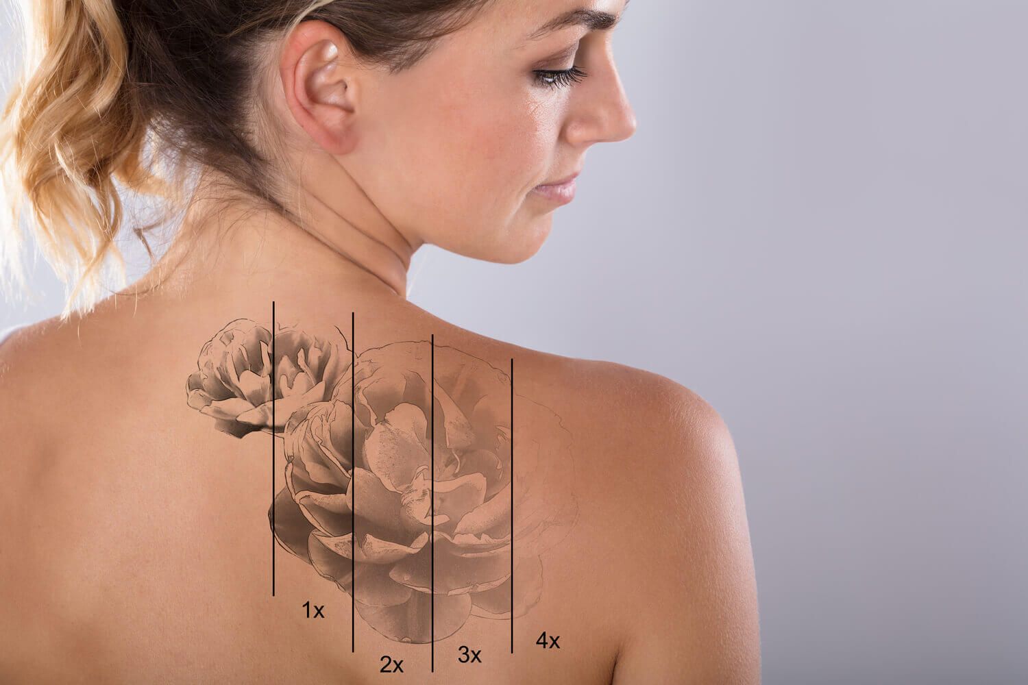 Is Laser Tattoo Removal Treatment Suitable for Tattoos?