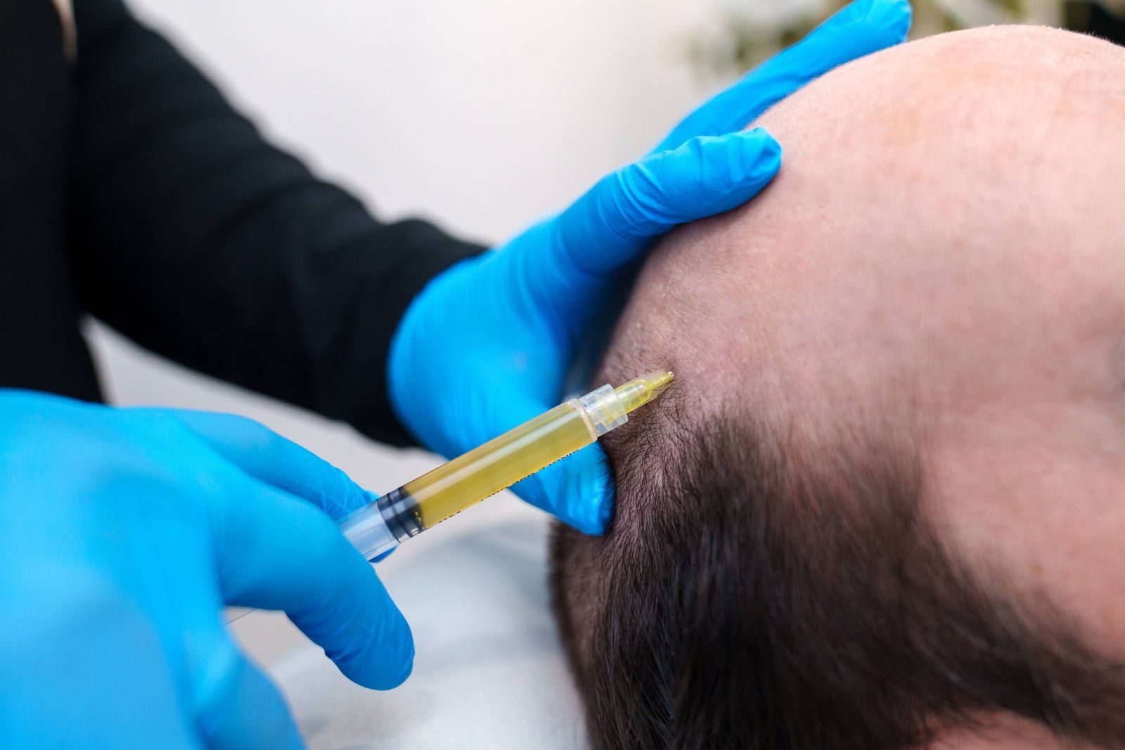 How Does Hair Shedding Relate to GFC Hair Restoration?